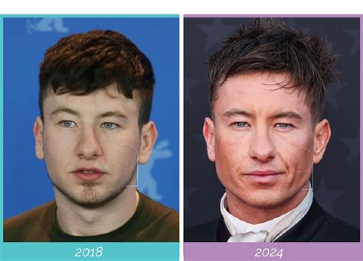 Barry Keoghan Plastic Surgery Natural Evolution or Hollywood Makeover?