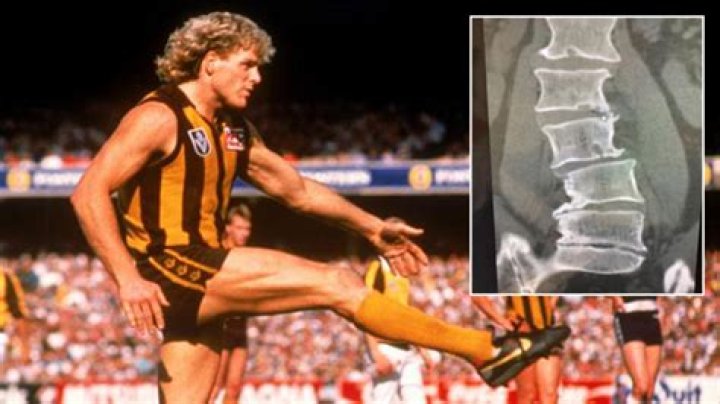 Dermott Brereton injury Former Hawks star&rsquo;s horrifying back Xrays