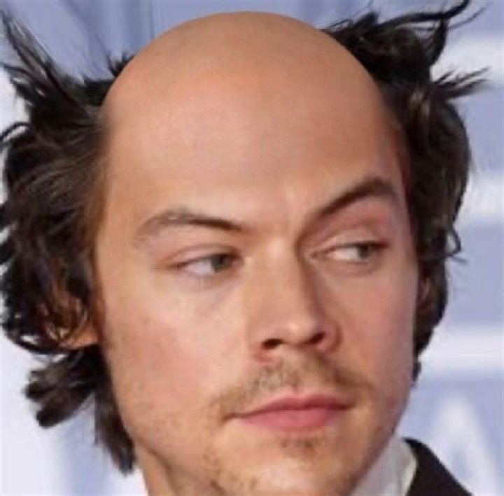 Harry bald styles Harry styles hair, Bald person, Harry styles
