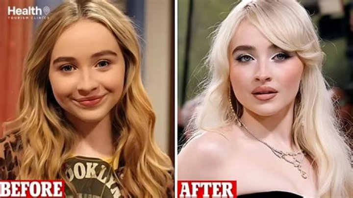 Sabrina Carpenter Plastic Surgery Botox And Lip Filler