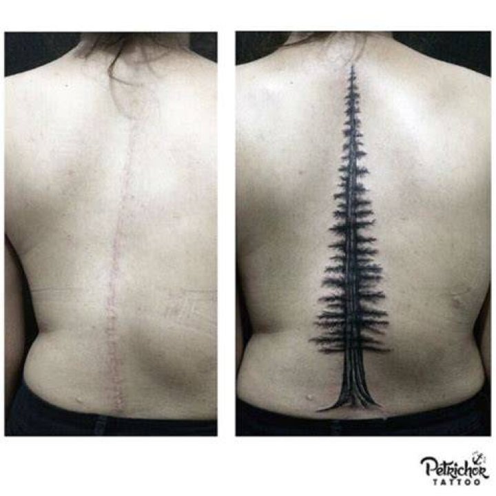 Scoliosis Surgery Scar Tattoo with Pictures Fitoont
